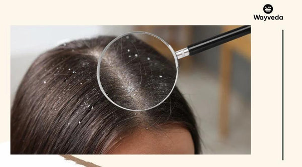 15 Ways To Cure Dandruff - Best Home Remedies And Ways - Wayveda